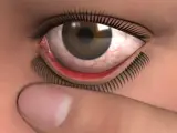 illustration of how to irrigate an eye