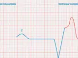 EKG 12-lead chart