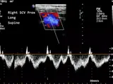 vessel mapping ultrasound