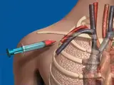 central venous catheterization illustration